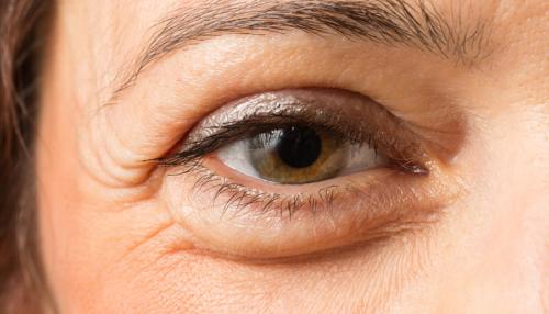 Как избавиться от хронических мешков под глазами. Причины появления мешков под глазами