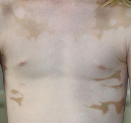 Причины появления пигментных пятен на теле. Виды пигментных пятен 05 Причины появления пигментных пятен на теле. Виды пигментных пятен 05