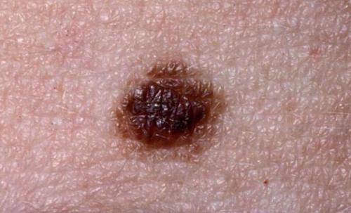Опасные и неопасные родинки. Родинки на теле 04