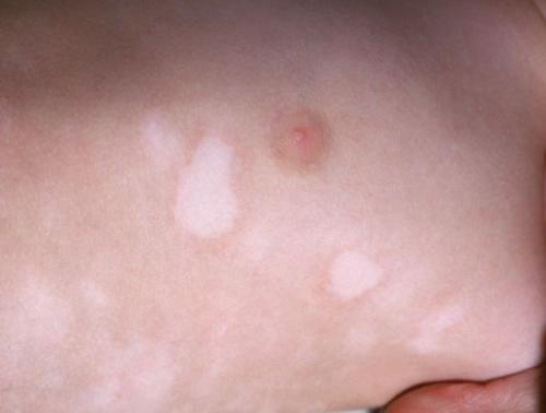 Причины возникновения пигментных пятен на кистях рук. Пигментация на кистях рук 05