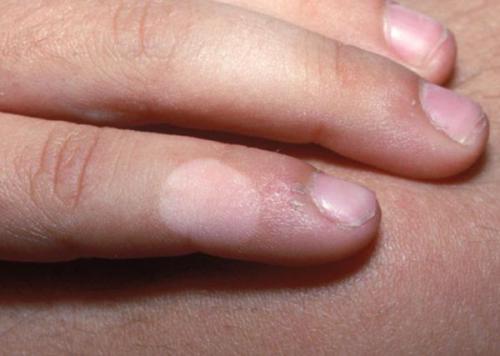 Причины возникновения пигментных пятен на кистях рук. Пигментация на кистях рук 08