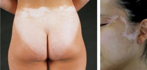 Эффективные методы борьбы с пигментацией Блог клиники ЛИЦА. Химический, или кислотный 09