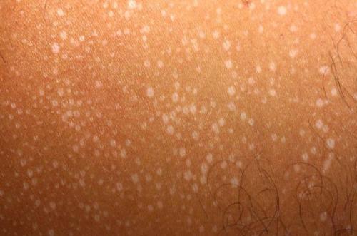 Эффективные методы борьбы с пигментацией Блог клиники ЛИЦА. Химический, или кислотный 12