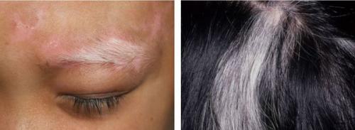 Эффективные методы борьбы с пигментацией Блог клиники ЛИЦА. Химический, или кислотный 03