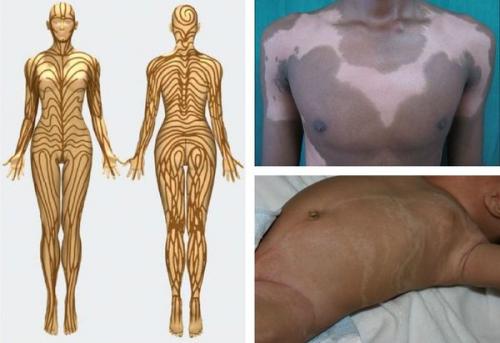 Эффективные методы борьбы с пигментацией Блог клиники ЛИЦА. Химический, или кислотный 10