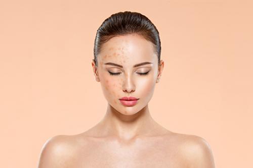 Эффективные методы борьбы с пигментацией Блог клиники ЛИЦА. Химический, или кислотный 01