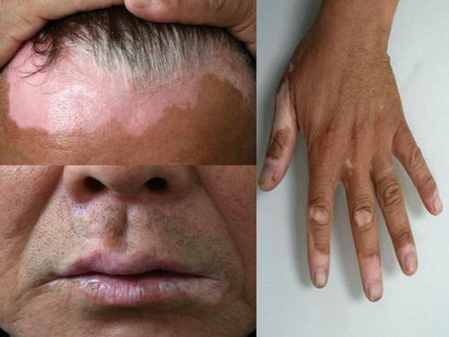 Эффективные методы борьбы с пигментацией Блог клиники ЛИЦА. Химический, или кислотный 06