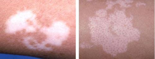 Желтые пятна на коже. О чем сигнализирует изменение цвета кожи 01 Желтые пятна на коже. О чем сигнализирует изменение цвета кожи 01