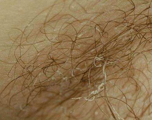 Сухие пятна на коже. Определение болезни. Причины заболевания 02 Сухие пятна на коже. Определение болезни. Причины заболевания 02