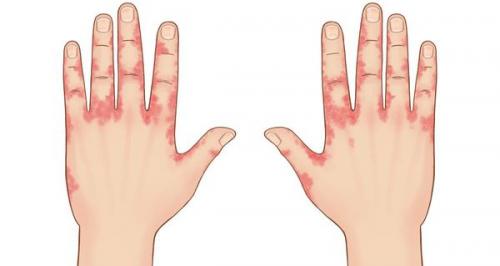 Какими мазями можно лечить дерматит. Какими негормональными мазями можно лечить дерматит 01