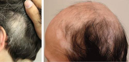 Почему на руках появляются пигментные пятна.. Определение болезни. Причины заболевания 01