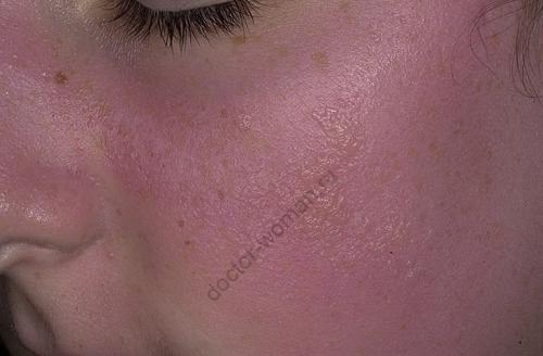 Жированная кожа, как отличить. В чем разница между типом и состоянием кожи?