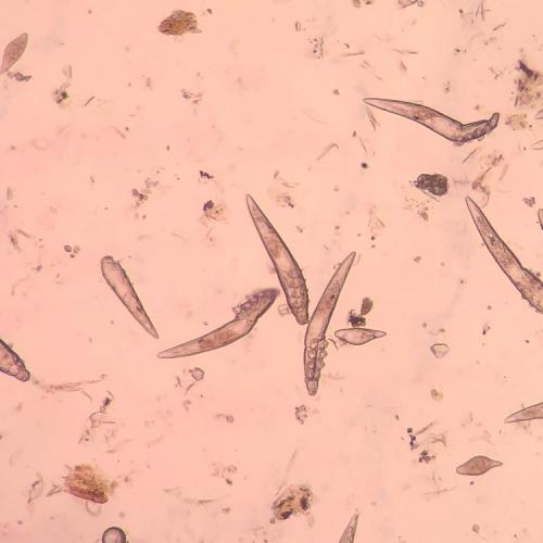 Как ДЕМОДЕКОЗ век влияет на остроту зрения. Демодекоз век — описание, причины и лечение