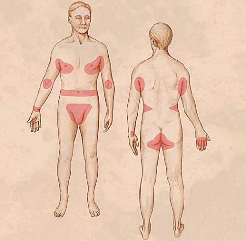 Подкожный клещ: что это такое и как от него избавиться 03
