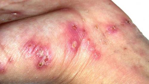 Подкожный клещ: что это такое и как от него избавиться 02