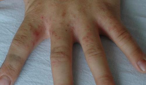 Подкожный клещ: что это такое и как от него избавиться 01