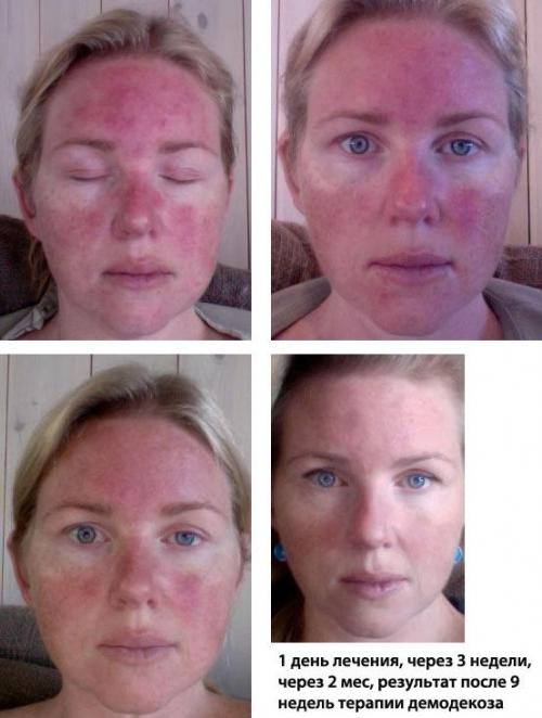Демодекоз на лице: причины, симптомы и методы лечения 02