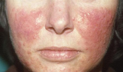 Как правильно применять народные средства для избавления от демодекса. Почему возникает заболевание