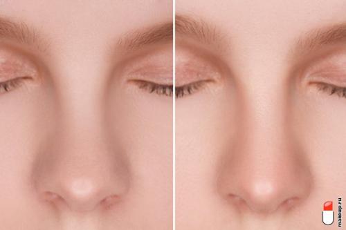 Контуринг носа сужение. Курсы моделирования: как сделать контуринг носа?