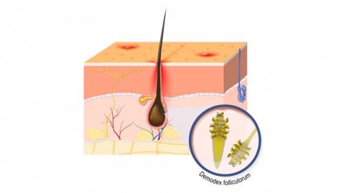 Что такое демодекоз и как от него избавиться. Причины 03 Что такое демодекоз и как от него избавиться. Причины 03