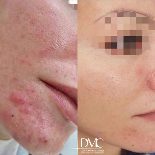 ФАРМАТЕКА » Принципы терапии демодекоза. Лечение демодекоза глаз 06 ФАРМАТЕКА » Принципы терапии демодекоза. Лечение демодекоза глаз 06