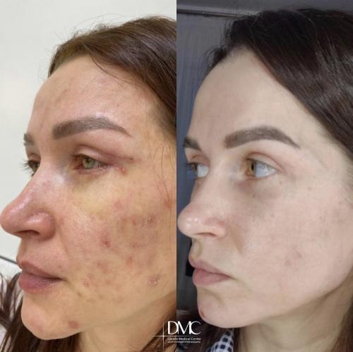 Демодекоз лечение на лице. Клещ демодекс на лице и глазах 05