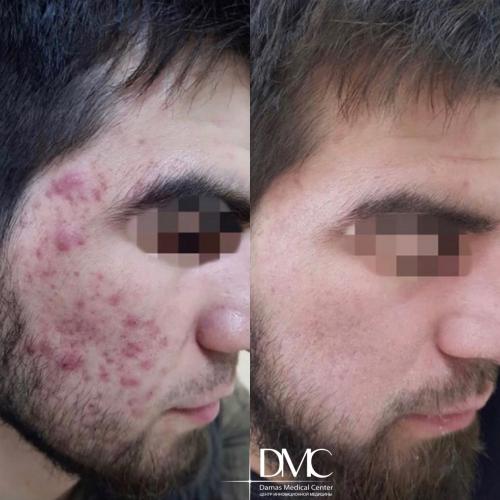 Демодекоз лечение на лице. Клещ демодекс на лице и глазах 07