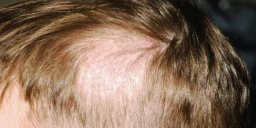 Стригущий лишай, как лечить быстро. Стригущий лишай у человека