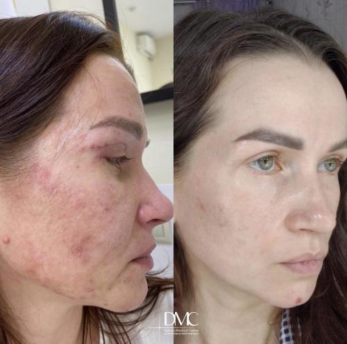 Так ли страшен демодекс. Демодекс — клещ, которого не нужно бояться 04 Так ли страшен демодекс. Демодекс — клещ, которого не нужно бояться 04