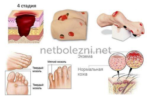 Как можно ускорить заживление ран. 10 лучших мазей для заживления ран на коже 06 Как можно ускорить заживление ран. 10 лучших мазей для заживления ран на коже 06
