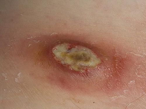 Как можно ускорить заживление ран. 10 лучших мазей для заживления ран на коже 11 Как можно ускорить заживление ран. 10 лучших мазей для заживления ран на коже 11