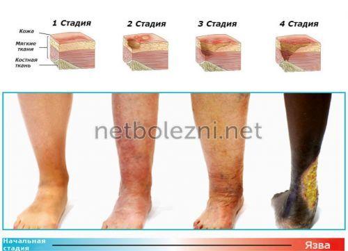 Как можно ускорить заживление ран. 10 лучших мазей для заживления ран на коже 03 Как можно ускорить заживление ран. 10 лучших мазей для заживления ран на коже 03