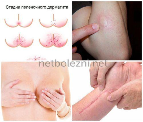 Как можно ускорить заживление ран. 10 лучших мазей для заживления ран на коже 08 Как можно ускорить заживление ран. 10 лучших мазей для заживления ран на коже 08