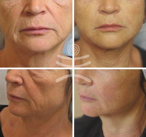 Подтяжка лица после 55 лет. Аппаратные процедуры