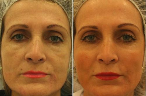 Подтяжка лица после 55 лет. Аппаратные процедуры