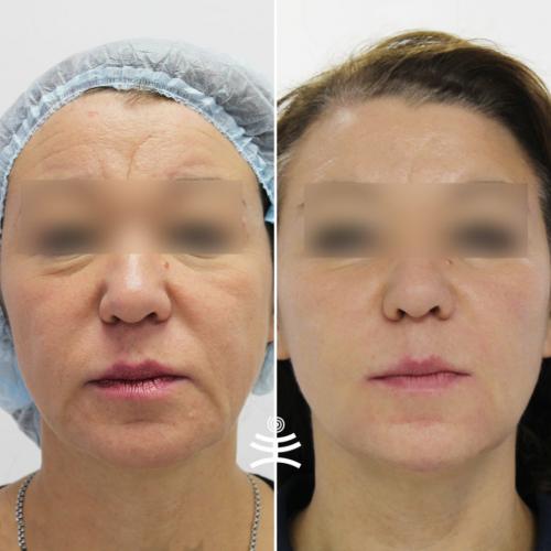 Подтяжка лица после 55 лет. Аппаратные процедуры