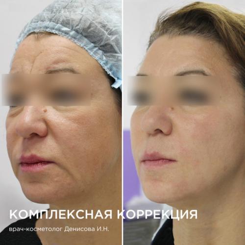 Подтяжка лица после 55 лет. Аппаратные процедуры