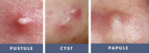 Как избавиться от постакне на лице. Избавление от постакне: процедура 06