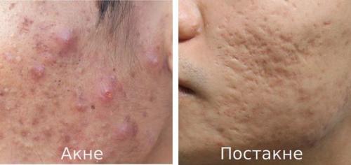 Как избавиться от постакне на лице. Избавление от постакне: процедура 05