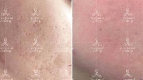 Как избавиться от постакне на лице. Избавление от постакне: процедура 01