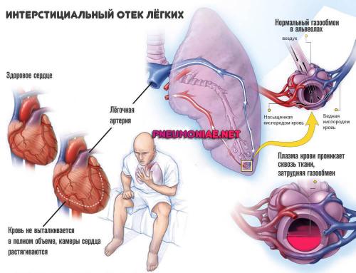 Как я вылечила хронический бронхит. Механизм становления и причины