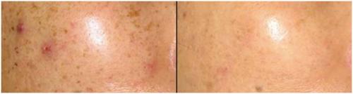 О, каких болезнях говорят пигментные пятна на лице. Формы гиперпигментации