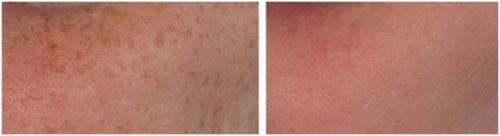 О, каких болезнях говорят пигментные пятна на лице. Формы гиперпигментации