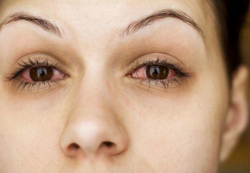 7 скрытых опасностей наращивания ресниц. Офтальмолог раскрыла россиянкам опасность наращивания ресниц 01