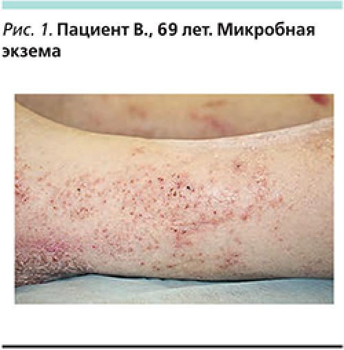 Какие кожные болезни наиболее распространены у пожилых людей. Виды поражений кожи в пожилом возрасте