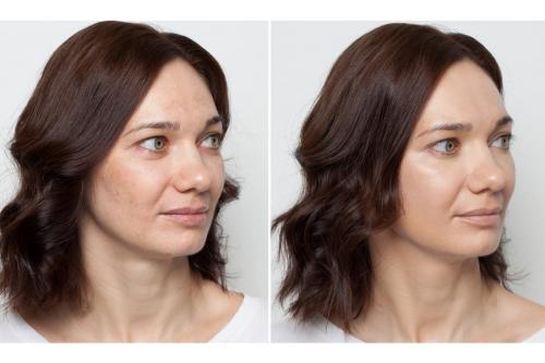 Нейтрализовать красноту прыщика поможет зелёный консилер. Разбираемся в многообразии цветов 15 Нейтрализовать красноту прыщика поможет зелёный консилер. Разбираемся в многообразии цветов 15