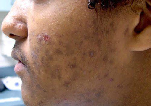 Как избавиться от старческих пятен на теле. Старческие пятна на коже 06