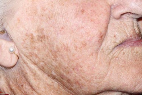 Как избавиться от старческих пятен на теле. Старческие пятна на коже 08