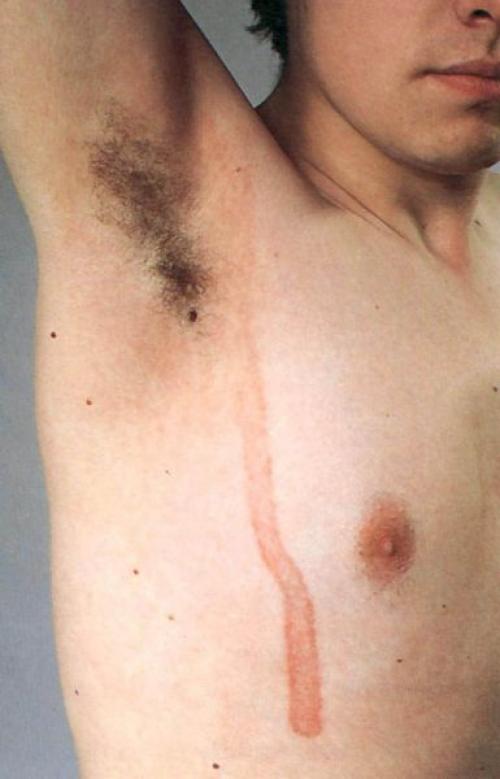 Как избавиться от старческих пятен на теле. Старческие пятна на коже 07