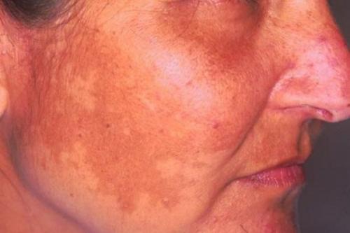 Пигментные пятна почему появляются и как избавиться. Пигментация на лице 02 Пигментные пятна почему появляются и как избавиться. Пигментация на лице 02